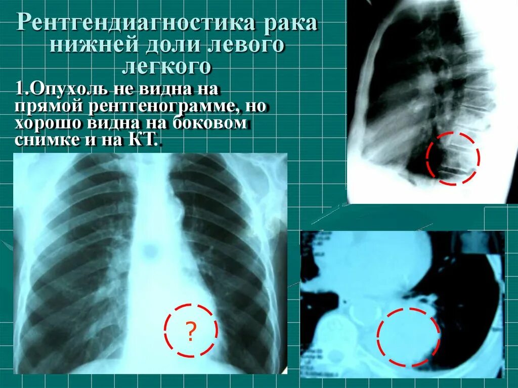 Периферическая опухоль верхней доли правого легкого кт. Опухоль левого легкого. Опухоль нижней доли легкого. Опухоль левого легкого верхней доли. Образование левой доли легкого