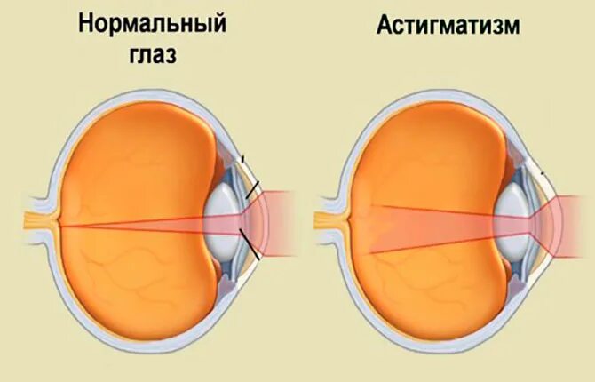 Ли вылечить астигматизм. Астигматизм фото. астигматизм левого глаза. зрение при астигматизме. что такое астигматизм зрения.