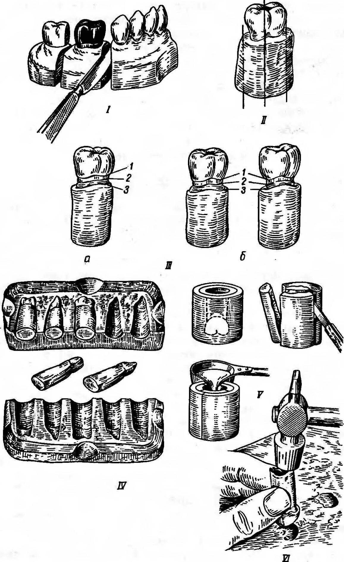 Этапы металлической штамповой коронки. Лабораторный этап штампованной коронки. Этапы изготовления штампованной коронки. Гипсовый блок для штампованных коронок. Штампованная коронка лабораторные этапы