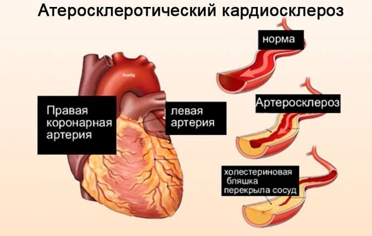 Атеросклеротический кардиосклероз что это простыми. Атеросклеротический кардиосклероз. инфаркт миокарда кардиосклероз. атеросклеротический и постинфарктный кардиосклероз. коронарный кардиосклероз что это.