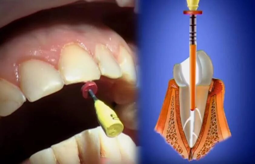 Пломбирование каналов зубов штифтами