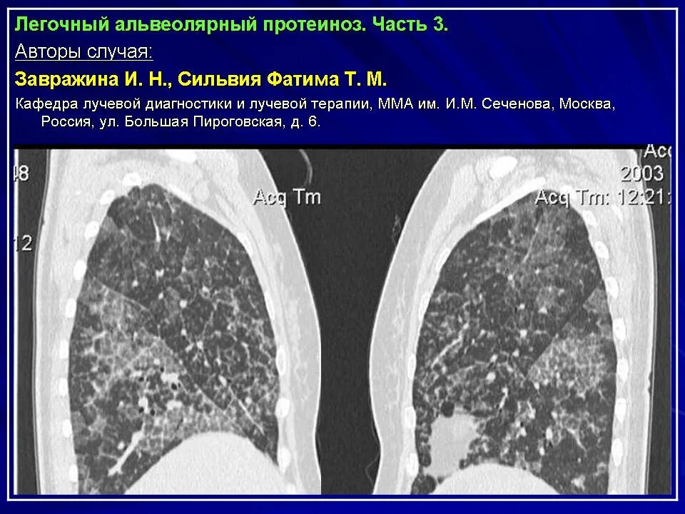 Альвеолярный протеиноз кт признаки. Идиопатический легочный фиброз. Легочный альвеолярный протеиноз кт. Фиброзирующий альвеолит на кт.