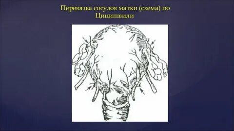 Перевязка артерий