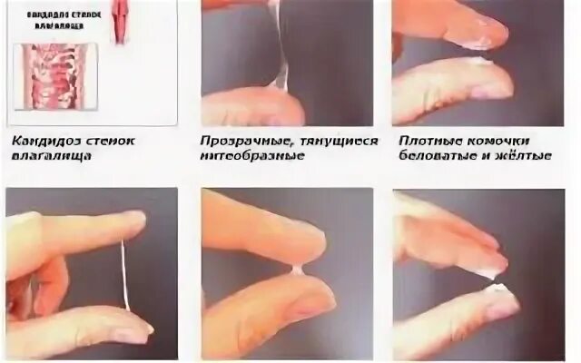 Что выделяется у мужчин при возбуждении. Выделения при молочнице молочнице. выделения при молочнице у мужчин. рецидивирующая молочница. кандидоз у мужчин белые выделения.