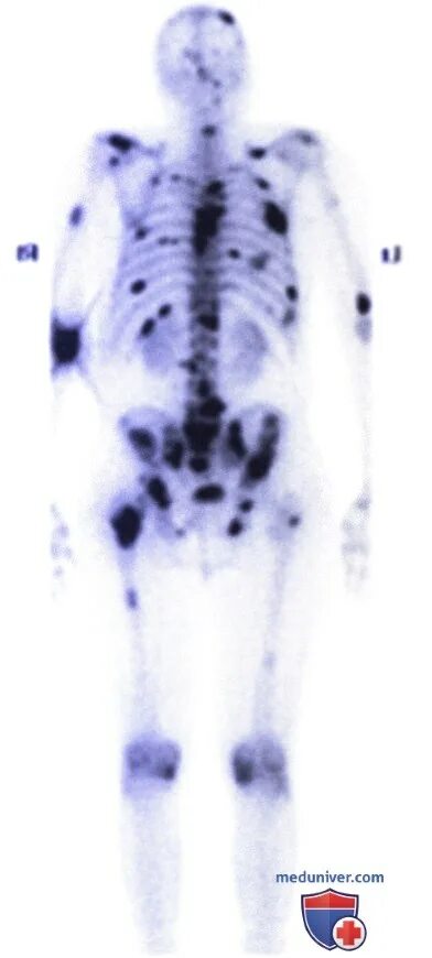 Метастатическое поражение кости. Сцинтиграфия костей метастазы. Сцинтиграфия метастазы в костях. Сцинтиграфия на костные метастазы. Множественные метастазы в костях.