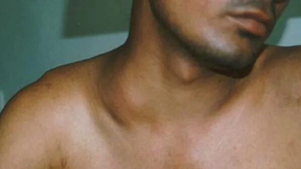 Cancerous Lumps Behind Ear B77