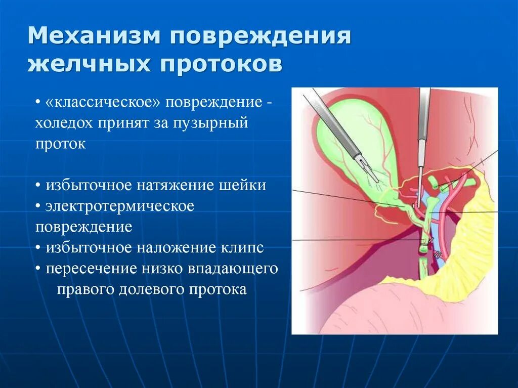 Симптомы забитых желчных протоков. Послеоперационная стриктура желчного протока. Стенозов внепеченочных желчных протоков. Повреждения и стриктуры желчных протоков.