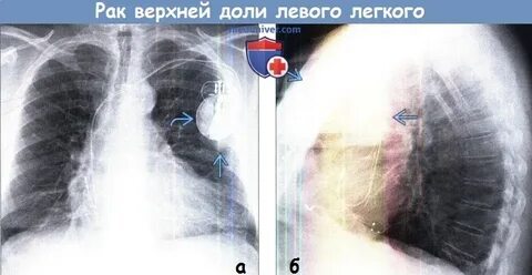 Пневмония в верхней доле левого легкого