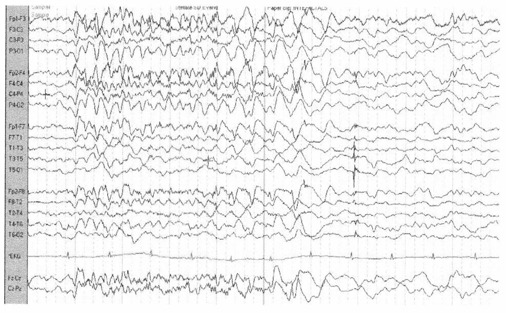 Фокальная эпилепсия на ЭЭГ. ЭЭГ паттерн фокального эпилептического приступа. Видеомониторинг ЭЭГ при эпилепсии. Снимок ЭЭГ при эпилепсии.