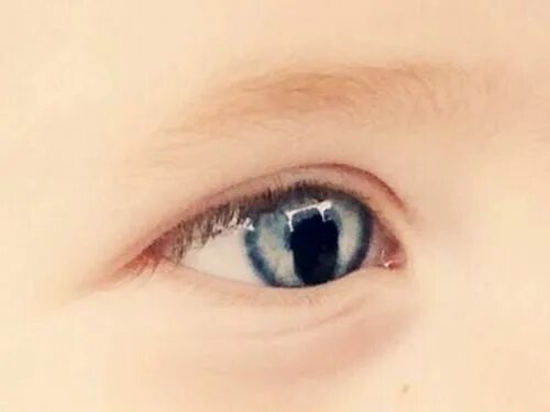 Колобом глаза. Колобом глаза. Колобома радужной сетчатки. Колобома зрачок кошачий глаз. Колобом глаза.