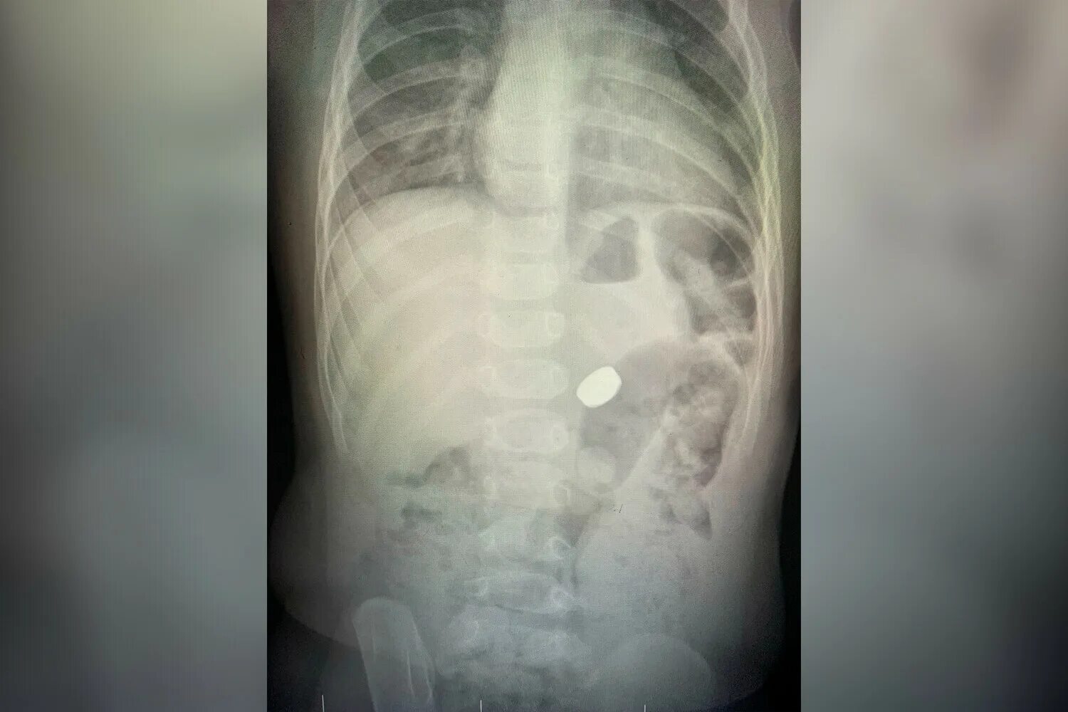 Что делать если проглотил батарейку. Инородное тело(металлическая проволока) пищевода. Ребенок съел сразу. Инородное тело в желудке у ребенка. Ребенок съел сразу.