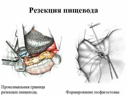 Эзофагостома
