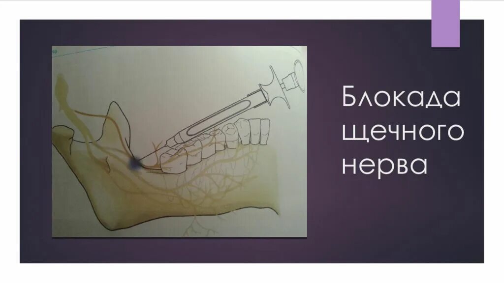 Нервная блокада. Обезболивание щечного нерва. Блокада щечного нерва анестезия. Анестезия щечного нерва методика.