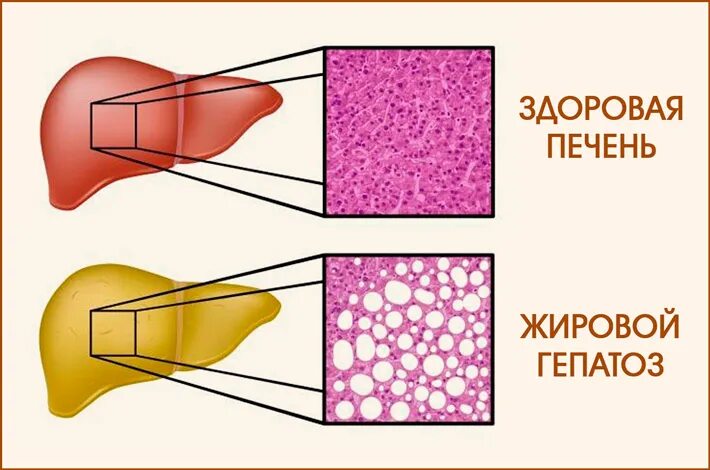 Как быстро восстанавливается печень при жировом гепатозе. Жировая инфильтрация печени механизм. жировой гепатоз печени. жировом гепатозе печени. жировая дистрофия печени биохимия.