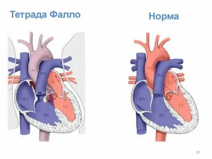 Тест общий артериальный ствол