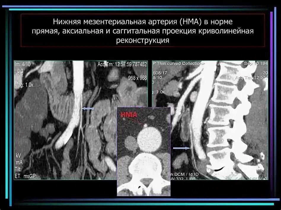 Тромбоз мезентериальных сосудов на кт. Мезентериальный тромбоз кт признаки. Мезентериальный атеросклероз. Тромбоз мезентериальных сосудов на УЗИ. Мезентериальный тромбоз мкб 10