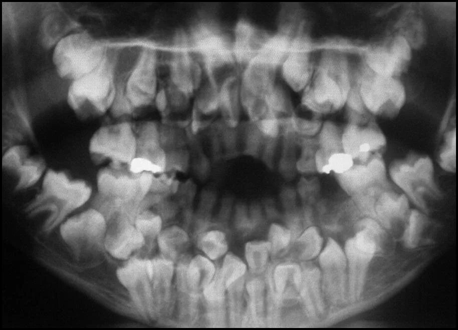 Аномалии удаления. Гипердонтия зубов рентген. Сверхкомплектные зубы аномалия. Сверхкомплектные зубы рентген.