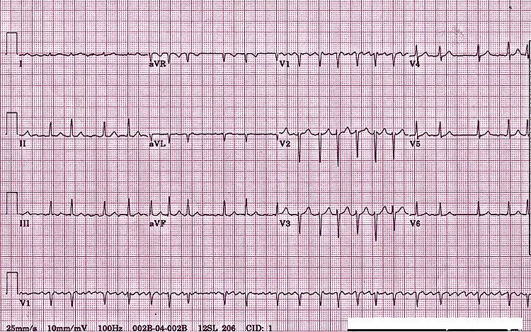 пароксизм фибрилляции предсердий на экг. трепетание и фибрилляция предсердий на экг. крупноволновая фибрилляция предсердий на экг. мерцательная аритмия на экг. пароксизмальная форма фибрилляции предсердий экг.