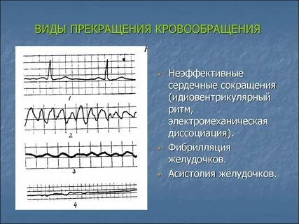 Идиовентрикулярный ритм