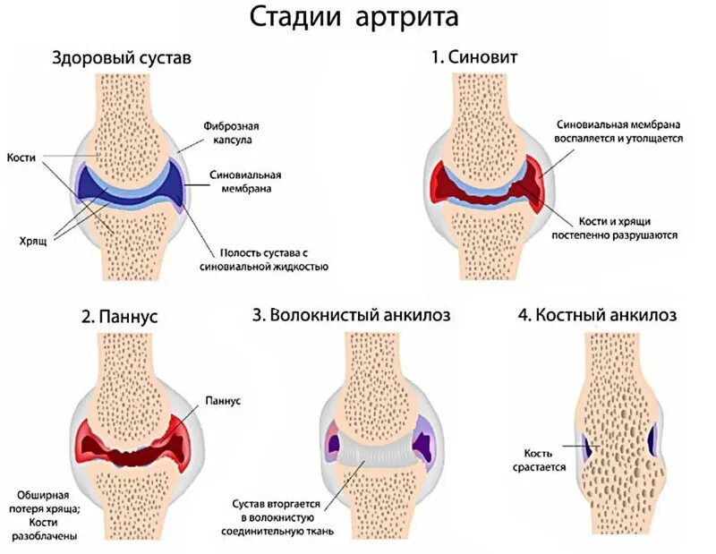 Сильные боли в костях и суставах. Этапы ревматоидного артрита. Степени ревматоидного артрита. Стадии ревматоидного остеоартрита. Стадии развития артрита.