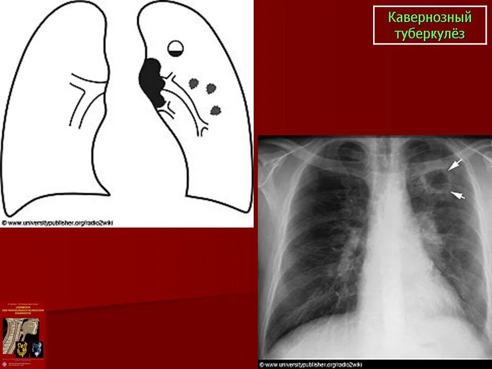 Фиброзно-кавернозный туберкулез кт. Каверна при туберкулезе на рентгене. Кавернозный туберкулез каверна. Фиброзно-кавернозный туберкулез рентген.