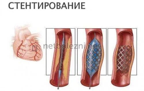 Стентирование инвалидность. Стентирование сосудов сердца осложнения. стентирование реабилитация. стентоник коронарные стенты.
