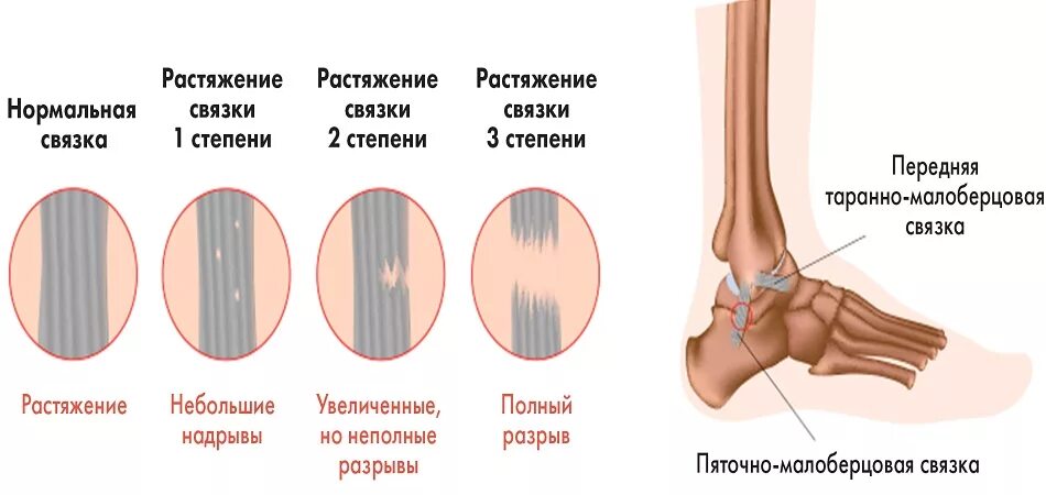 Трещина связке. Повреждение связки 1 степени. Капсульно связочный аппарат голеностопа.