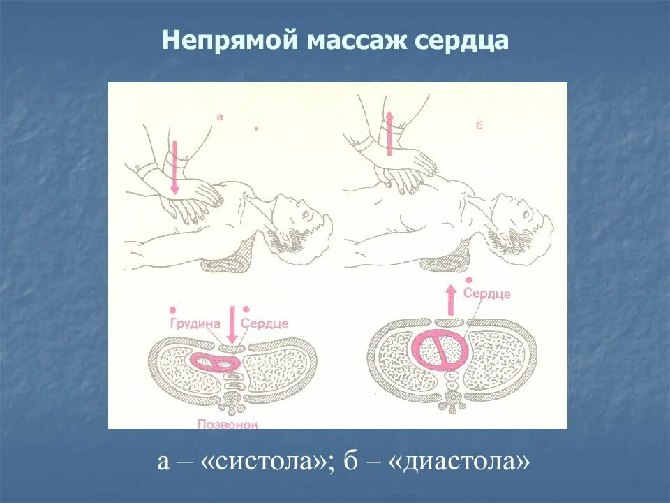 Как сделать массаж простаты. Непрямой массаж сердца презентация. прямой массаж сердца животных. непрямой массаж сердца создает кровообращение обеспечивающее до.