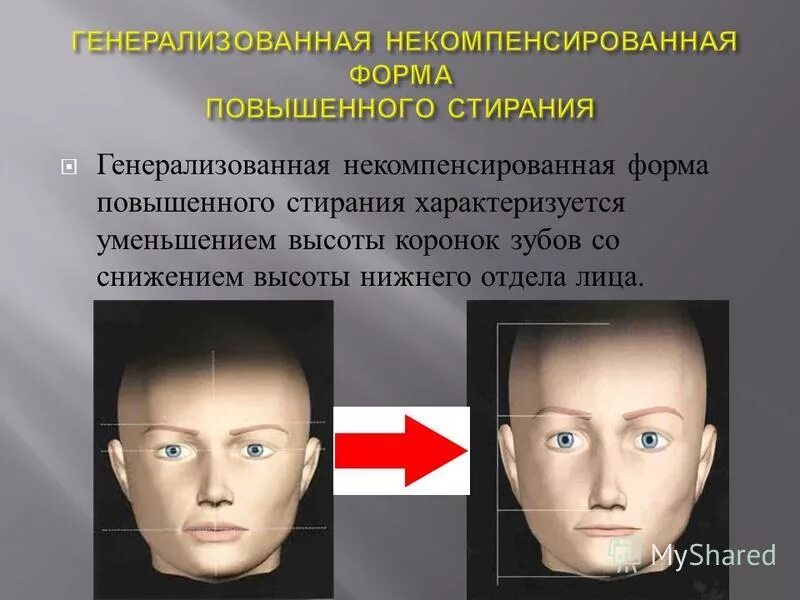 снижение высоты нижнего отдела лица. глубокий прикус исправление. артроз внчс классификация. снижение высоты нижнего отдела лица. высота нижнего отдела лица это.