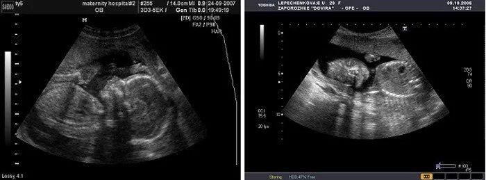 Узи беременности визуализация затруднена. Лицо ребенка на УЗИ 20 недель. УЗИ 20 недель беременности лицо. Что такое визуализация при беременности на УЗИ затруднена. Визуализация плода на УЗИ.
