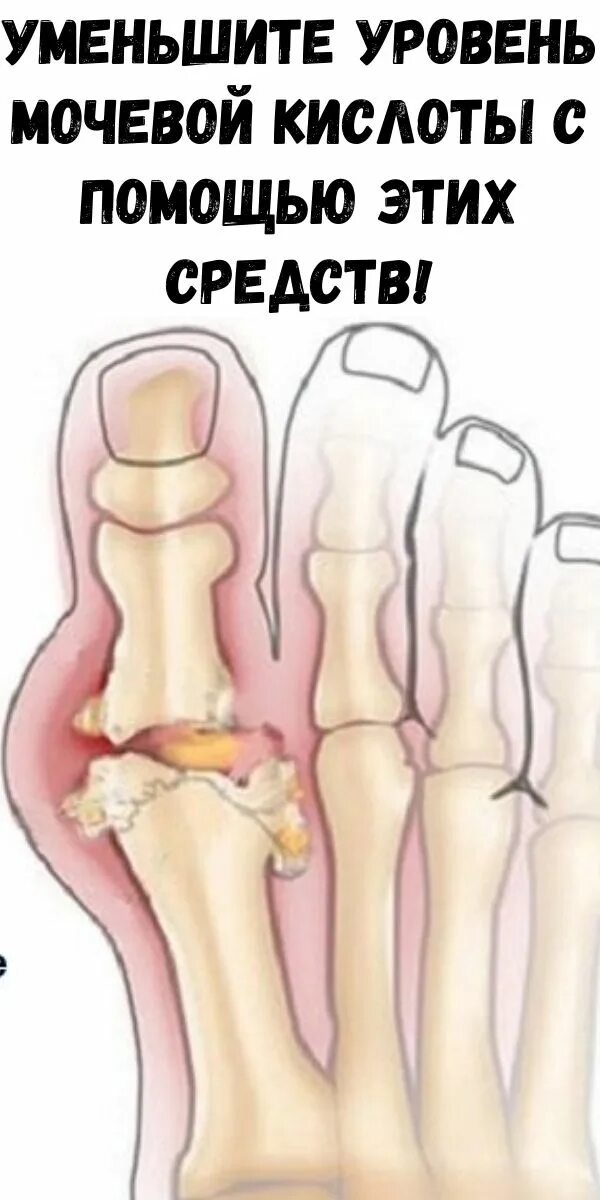 Народные средства понижающие мочевую кислоту. Уменьшение мочевой кислоты. Снизить мочевую кислоту. Снизить уровень мочевой кислоты. Как избавиться от мочевой кислоты в организме.