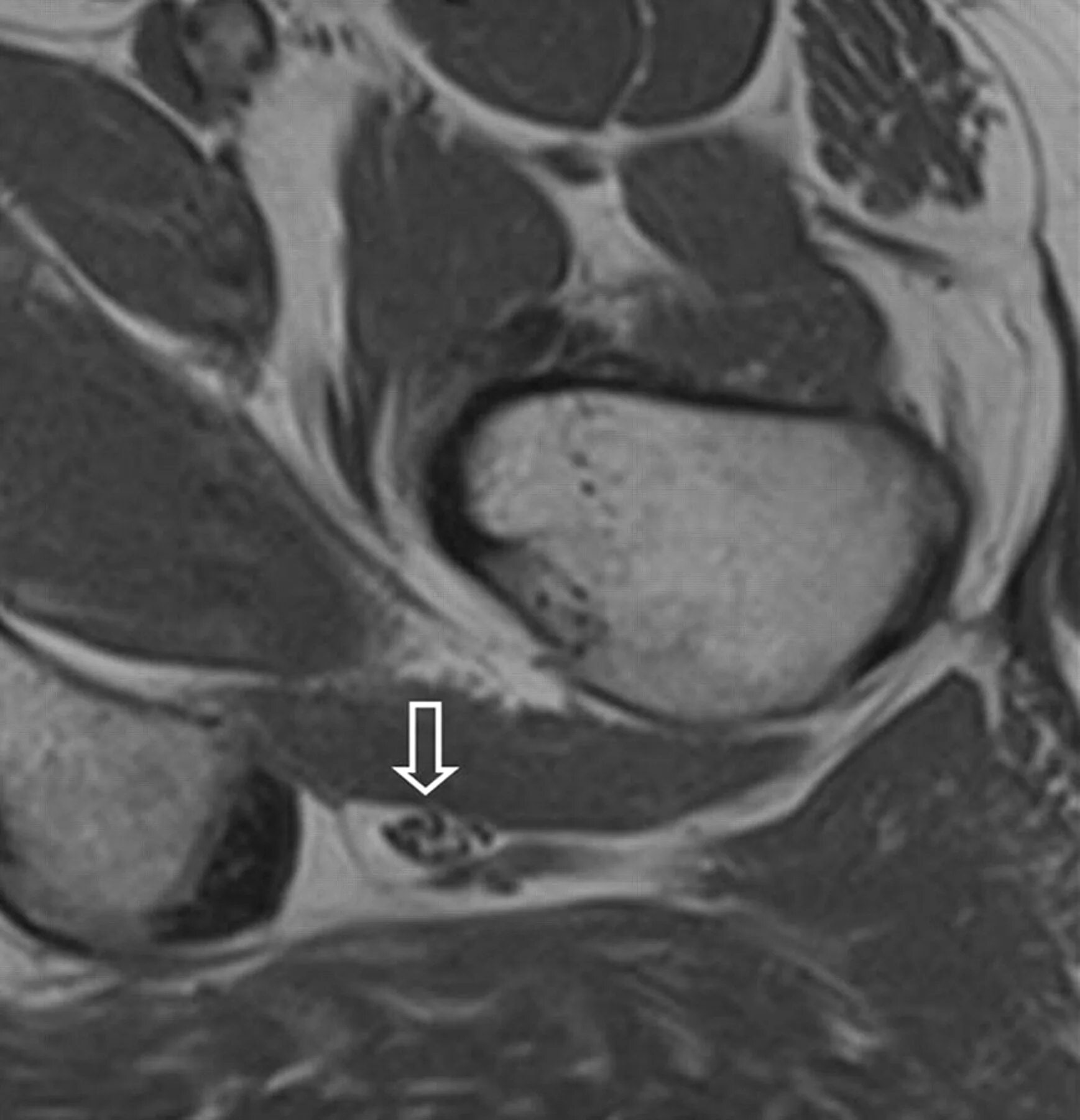 Защемление нерва l5 s1. Защемление седалищного нерва на мрт. Мрт снимок седалищный нерв. Показывает ли мрт нервы. Мрт центральной нервной системы.