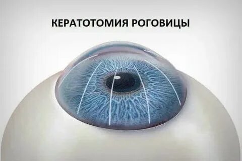 Коррекция зрения при астигматизме отзывы