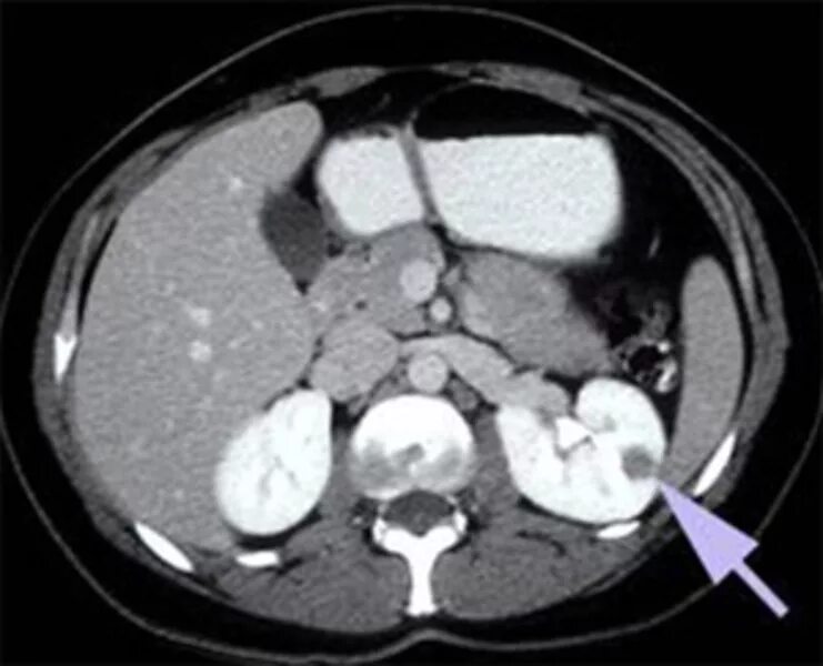 Папиллярная опухоль почки кт. Светлоклеточная карцинома почки кт. Папиллярная карцинома почки кт. На кт видно опухоль