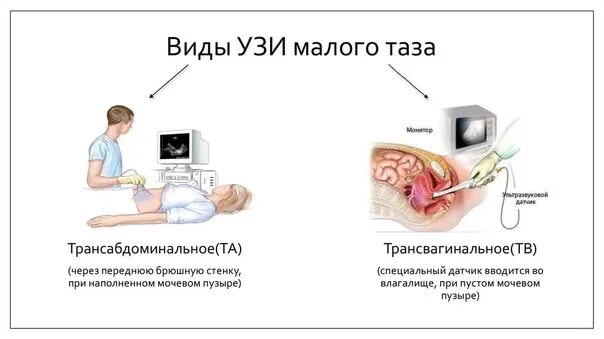 Узи Малого Таза У Девственниц