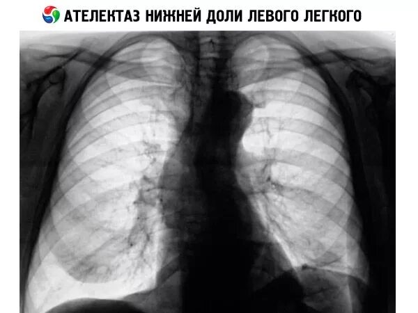 Ателектаз s5. Обтурационный ателектаз легкого рентген. Компрессионный ателектаз рентген. Дисковидный ателектаз рентген. Ателектаз нижнего легкого