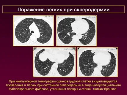 Поражение легких