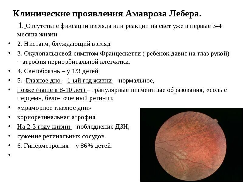 Синдром лебера тип наследования. Наследственная атрофия зрительного нерва лебера. наследственная оптическая нейропатия лебера. атрофия зрительного нерва лебера генетика.