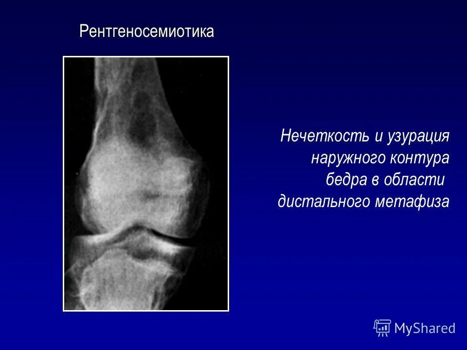 узурация суставных поверхностей. 3 стадия рентгена при ревматоидном артрите. ревматоидный артрит кисти рентген. узурация суставных поверхностей. ревматоидный артрит кисти рентген.