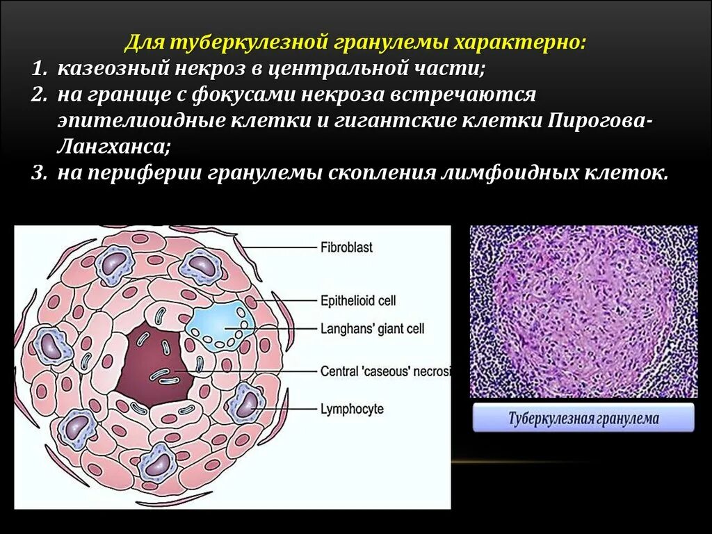Клеточная гранулема. Клеточная гранулема. Туберкулез червеобразного отростка микропрепарат. Клеточная гранулема. Эпителиоидно клеточная гранулема.