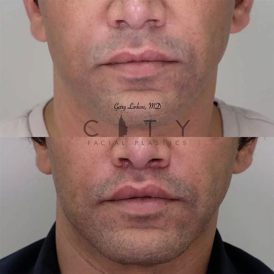 Lip Lift , subnasal, bullhorn , Dr. James Pearson Facial Plastic Surgery Facial 