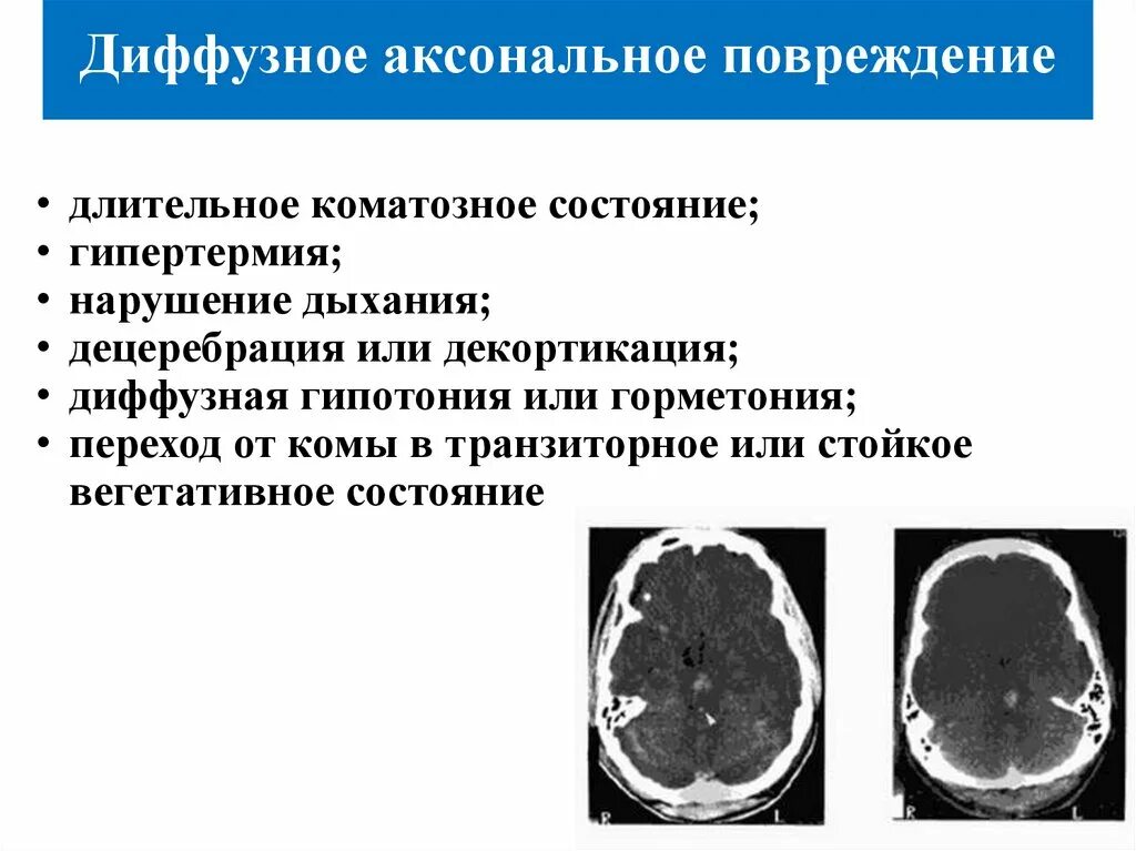Аксональное повреждение мозга. Аксональное повреждение головного мозга лечение. Диффузное аксональное повреждение кт. Диффузное аксональное повреждение мозга. Диффузное аксональное повреждение головного мозга кт.