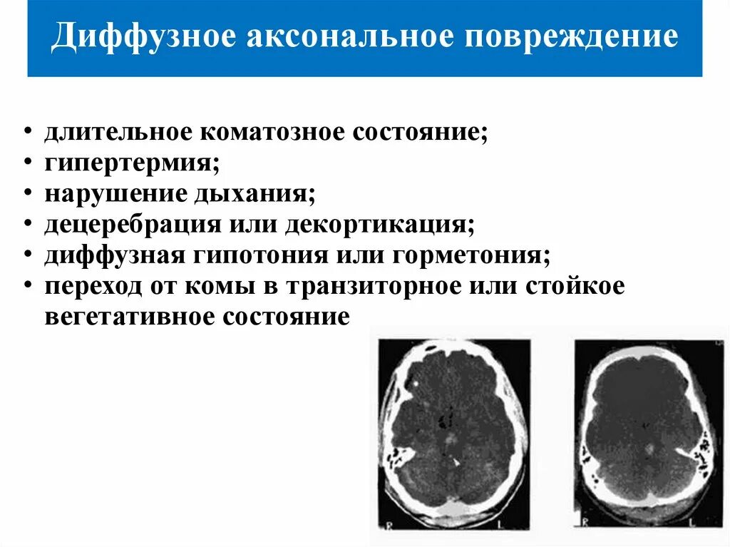 Аксональное повреждение головного. Аксональное повреждение головного мозга лечение. Диффузное аксональное повреждение кт. Диффузное аксональное повреждение мозга. Диффузное аксональное повреждение головного мозга кт.