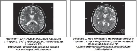 Лейкоареоз головного мозга что это