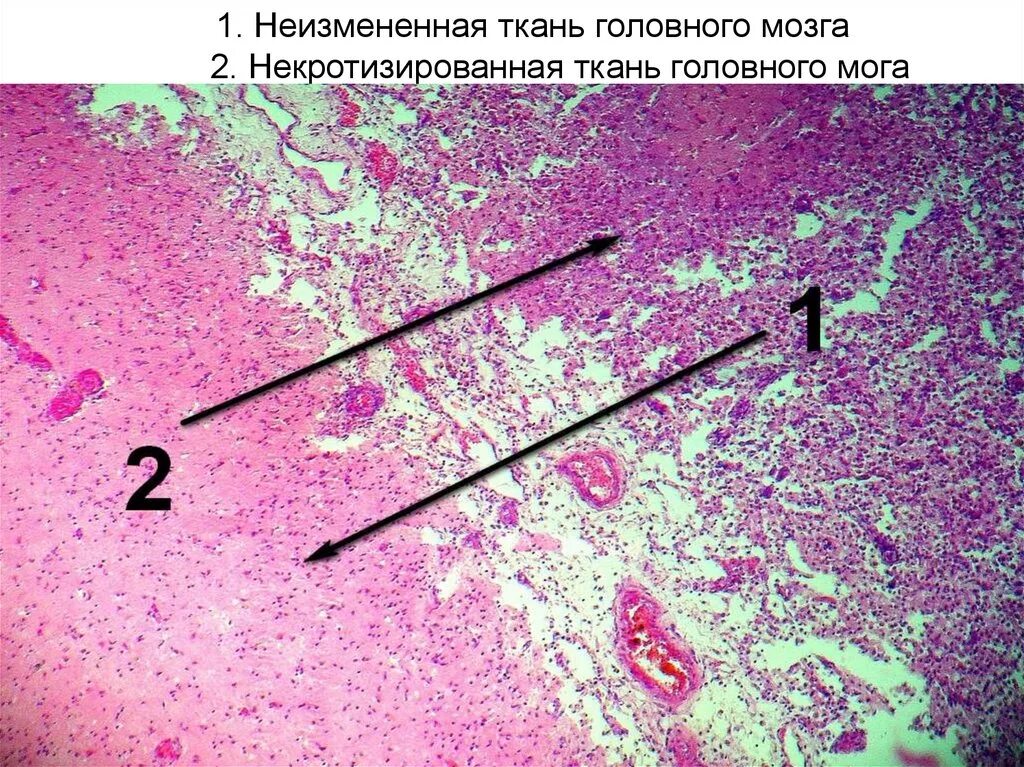 Микропрепарат головного мозга. Ишемический инфаркт мозга микропрепарат. Очаг размягчения головного мозга микропрепарат. Ишемический инфаркт гистология. Инфаркт головного мозга микропрепарат патанатомия.