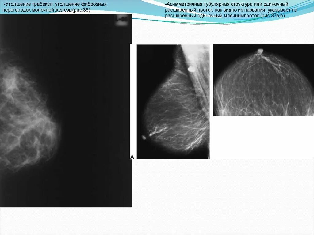 Утолщение молочной железы. Расширение протоков в молочной железе. Проток расширен в молочной железе. Методика исследования молочных желез. Кистозно расширенные железы