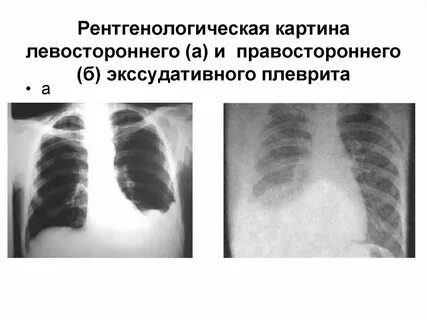 Рентгенологическая картина