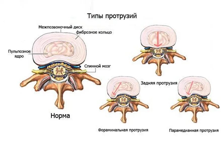 Протрузия межпозвоночного диска поясничного. Диффузная протрузия межпозвонкового диска. Протрузия диска l5-l6. Протрузии экструзии межпозвонковых дисков. Протрузия и экструзия межпозвонковых дисков поясничного отдела.