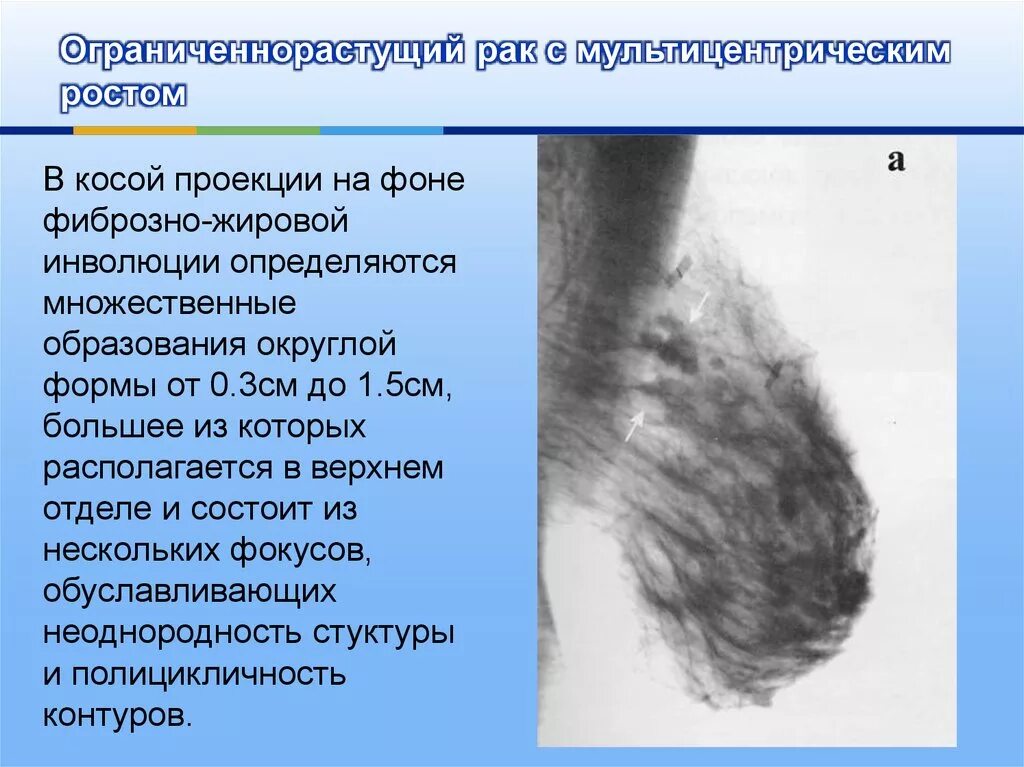 Молочных желез фиброзный. Инволютивные изменения молочных желез на маммографии. жировая инволюция молочных желез что это такое. мультицентрическая опухоль молочной железы. фиброзно-жировая инволюция молочных желез что это такое.