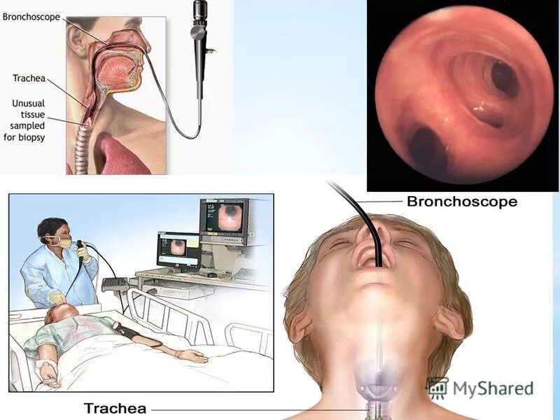 Бронхоскопия трахеобронхоскопия. Бронхоскопия и бронхография. Трансбронхиальная щипцовая биопсия. Биопсия легких как проводится
